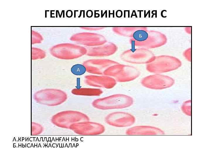 ГЕМОГЛОБИНОПАТИЯ С Б А А. КРИСТАЛЛДАНҒАН Hb C Б. НЫСАНА ЖАСУШАЛАР 