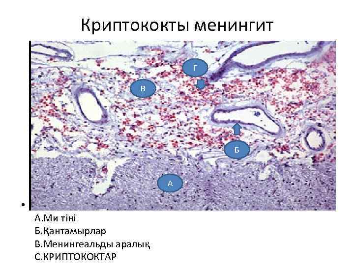 Криптококты менингит Г В Б А • А. Ми тіні Б. Қантамырлар В. Менингеальды