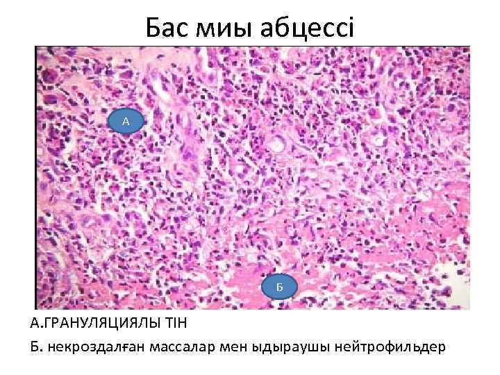 Бас миы абцессі А Б А. ГРАНУЛЯЦИЯЛЫ ТІН Б. некроздалған массалар мен ыдыраушы нейтрофильдер