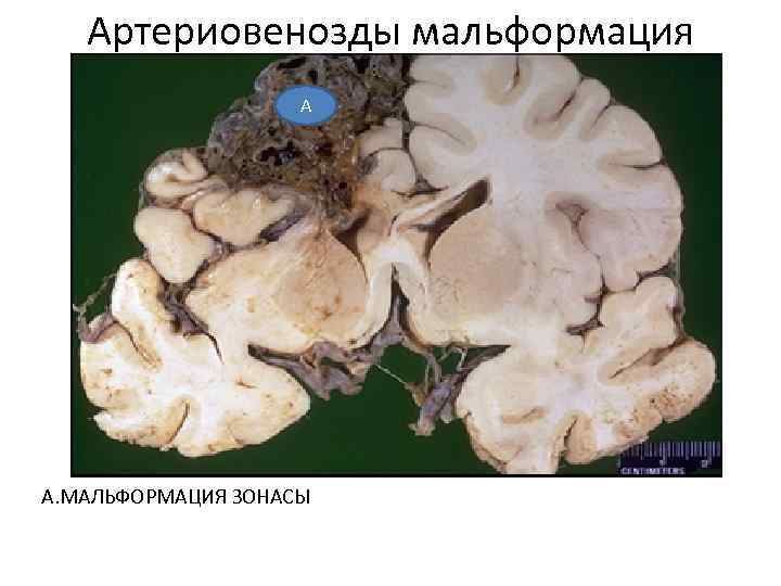 Артериовенозды мальформация А А. МАЛЬФОРМАЦИЯ ЗОНАСЫ 
