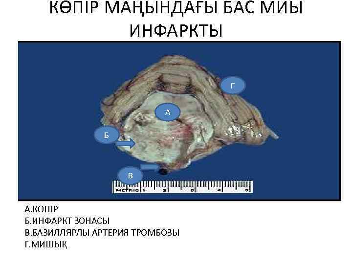 КӨПІР МАҢЫНДАҒЫ БАС МИЫ ИНФАРКТЫ Г А Б В А. КӨПІР Б. ИНФАРКТ ЗОНАСЫ