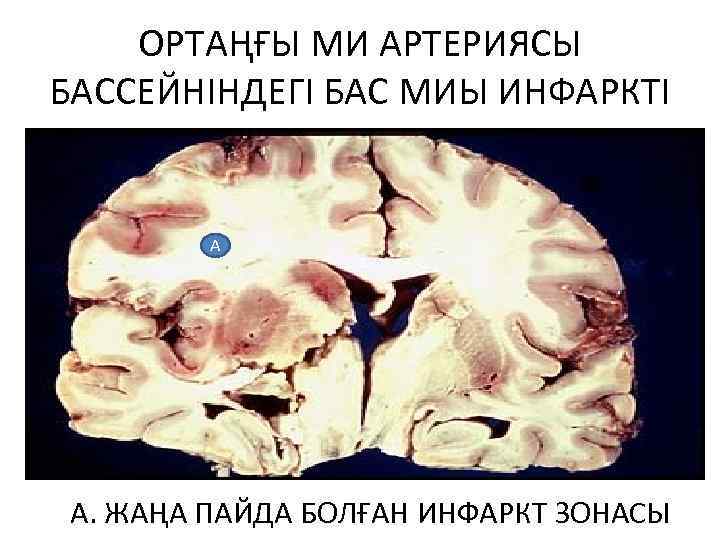 ОРТАҢҒЫ МИ АРТЕРИЯСЫ БАССЕЙНІНДЕГІ БАС МИЫ ИНФАРКТІ А • А. ЖАҢА ПАЙДА БОЛҒАН ИНФАРКТ