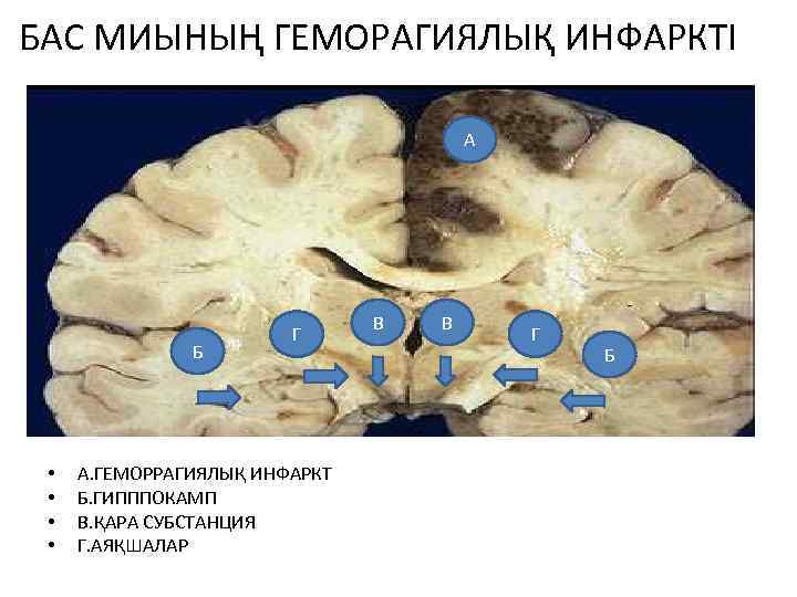 БАС МИЫНЫҢ ГЕМОРАГИЯЛЫҚ ИНФАРКТІ А Б • • Г А. ГЕМОРРАГИЯЛЫҚ ИНФАРКТ Б. ГИПППОКАМП