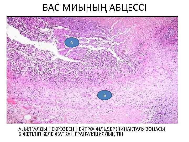 БАС МИЫНЫҢ АБЦЕССІ А Б • А. ЫЛҒАЛДЫ НЕКРОЗБЕН НЕЙТРОФИЛЬДЕР ЖИНАҚТАЛУ ЗОНАСЫ Б. ЖЕТІЛІП