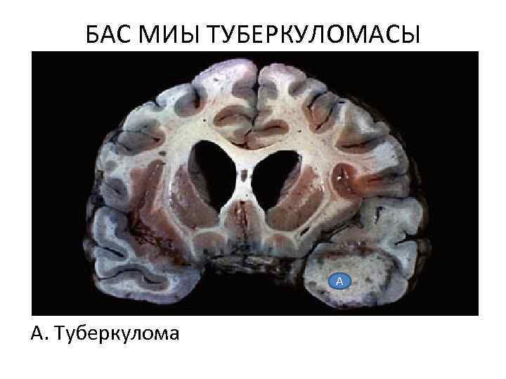 БАС МИЫ ТУБЕРКУЛОМАСЫ А А. Туберкулома 