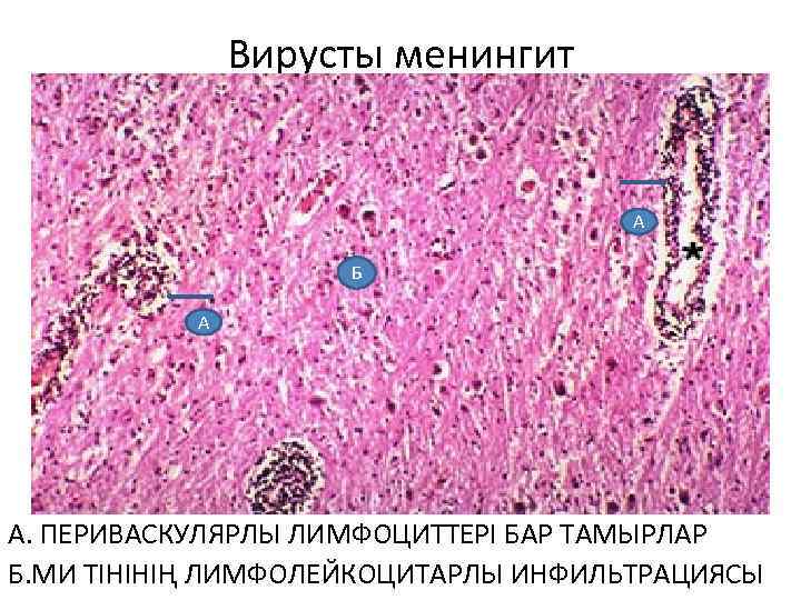 Вирусты менингит А Б А А. ПЕРИВАСКУЛЯРЛЫ ЛИМФОЦИТТЕРІ БАР ТАМЫРЛАР Б. МИ ТІНІНІҢ ЛИМФОЛЕЙКОЦИТАРЛЫ