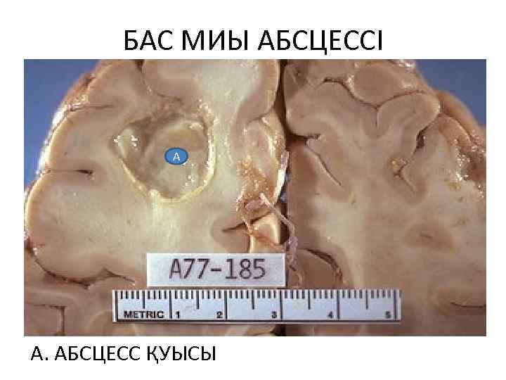 БАС МИЫ АБСЦЕССІ А А. АБСЦЕСС ҚУЫСЫ 