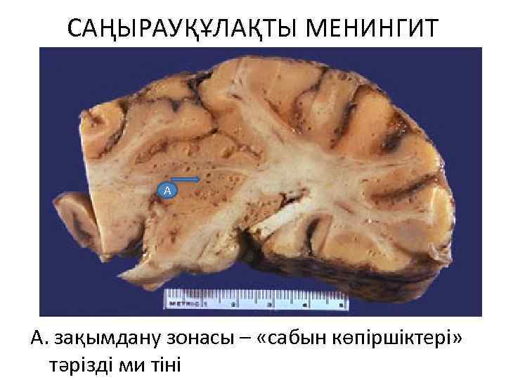 САҢЫРАУҚҰЛАҚТЫ МЕНИНГИТ А А. зақымдану зонасы – «сабын көпіршіктері» тәрізді ми тіні 