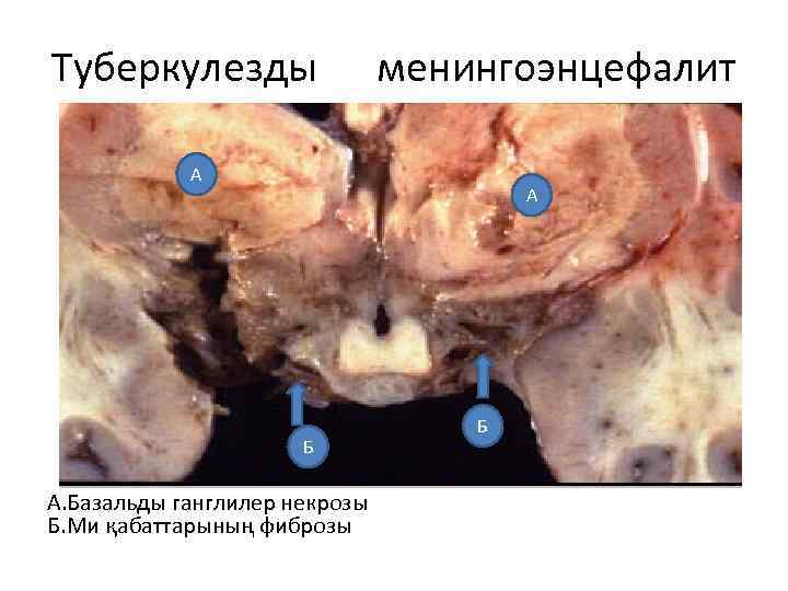 Туберкулезды менингоэнцефалит А А Б А. Базальды ганглилер некрозы Б. Ми қабаттарының фиброзы Б