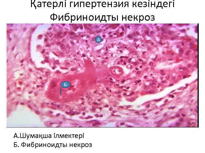 Қатерлі гипертензия кезіндегі Фибриноидты некроз А Б А. Шумақша ілмектері Б. Фибриноидты некроз 