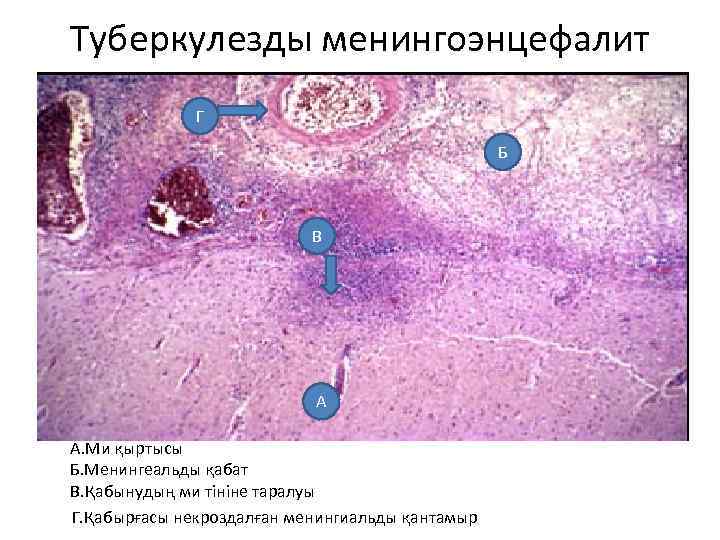 Туберкулезды менингоэнцефалит Г Б В А • А. Ми қыртысы Б. Менингеальды қабат В.
