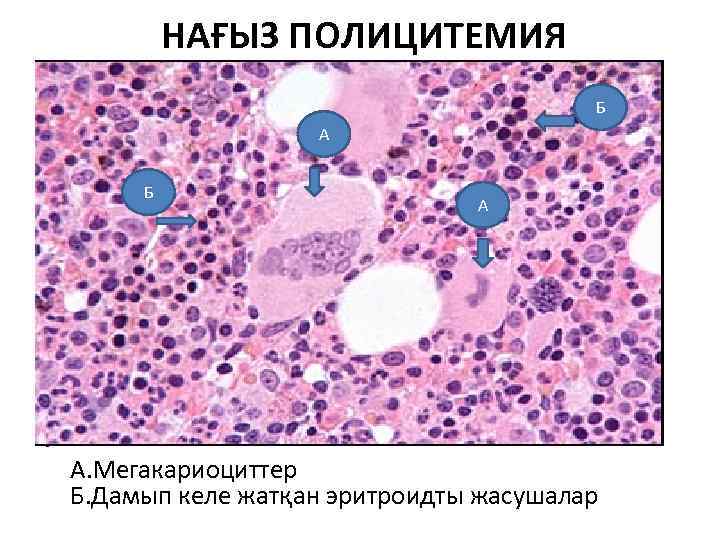  НАҒЫЗ ПОЛИЦИТЕМИЯ Б А Б • А А. Мегакариоциттер Б. Дамып келе жатқан