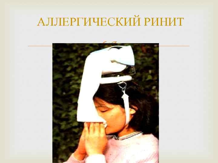 АЛЛЕРГИЧЕСКИЙ РИНИТ 