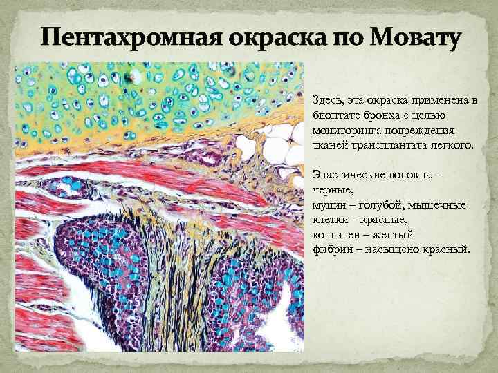 Пентахромная окраска по Мовату Здесь, эта окраска применена в биоптате бронха с целью мониторинга