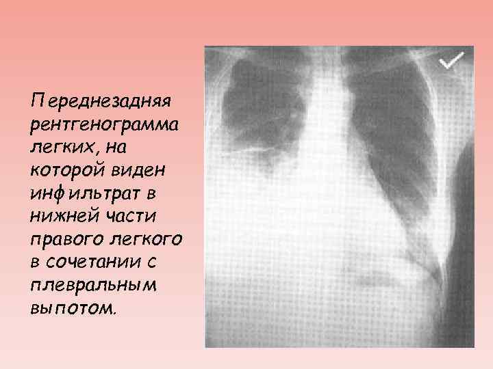 Переднезадняя рентгенограмма легких, на которой виден инфильтрат в нижней части правого легкого в сочетании