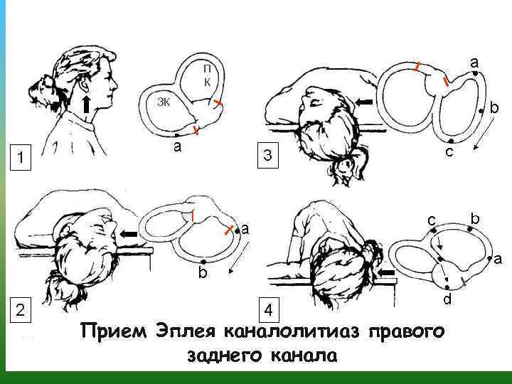 П К ЗК Прием Эплея каналолитиаз правого заднего канала 