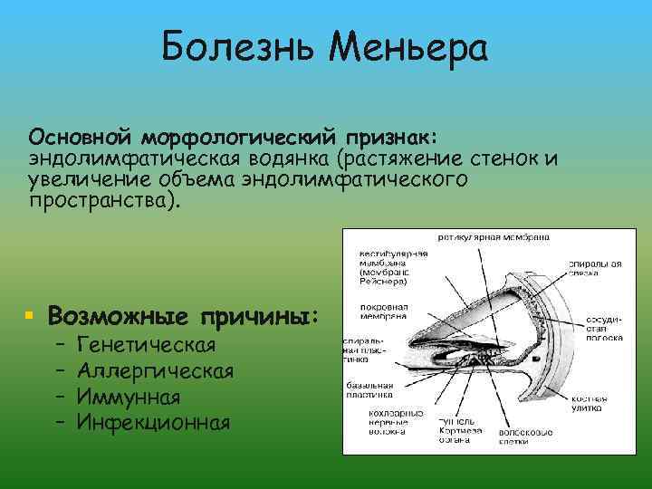 Болезнь Меньера Основной морфологический признак: эндолимфатическая водянка (растяжение стенок и увеличение объема эндолимфатического пространства).