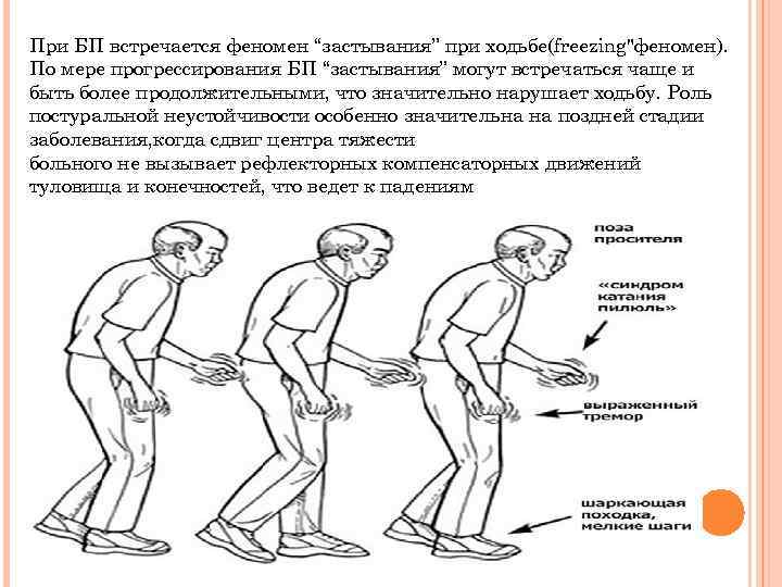 При БП встречается феномен “застывания” при ходьбе(freezing"феномен). По мере прогрессирования БП “застывания” могут встречаться