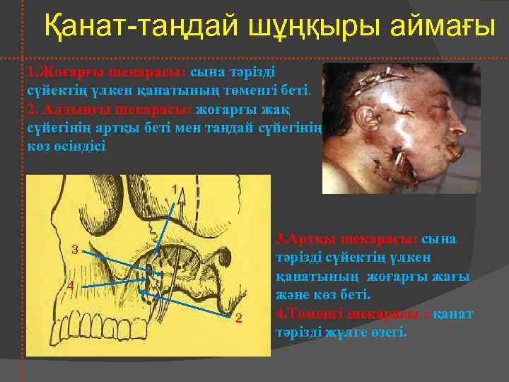 Қанат-таңдай шұңқыры аймағы 1. Жоғарғы шекарасы: сына тәрізді сүйектің үлкен қанатының төменгі беті. 2.