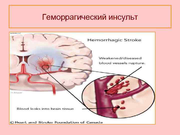 Геморрагический инсульт 