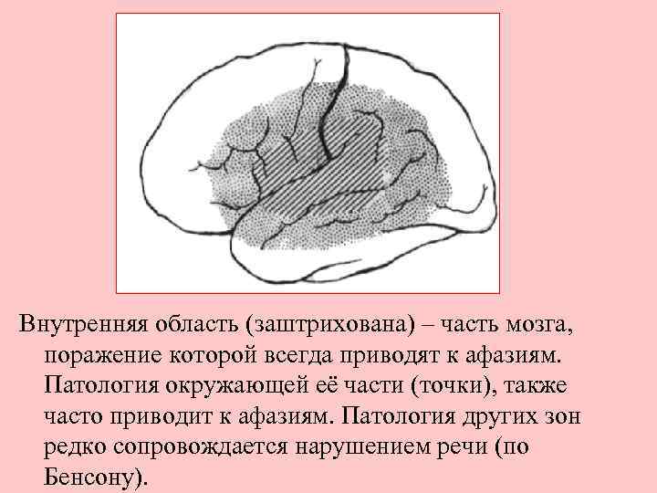 Внутренняя область (заштрихована) – часть мозга, поражение которой всегда приводят к афазиям. Патология окружающей