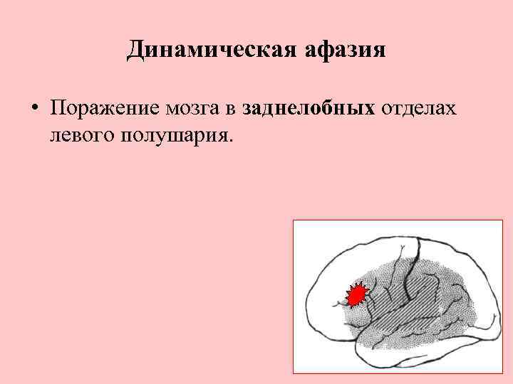 Динамическая афазия. Динамическая форма афазии. Динамическая афазия зоны мозга. Динамическая моторная афазия головного мозга. Локализация поражения при динамической афазии.