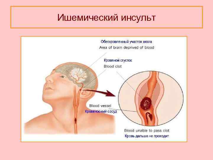 Ишемический инсульт 