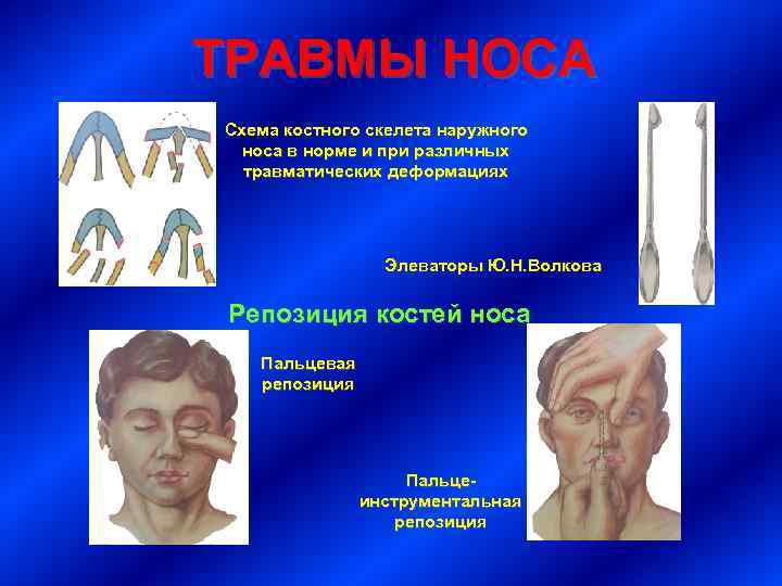 ТРАВМЫ НОСА Схема костного скелета наружного носа в норме и при различных травматических деформациях