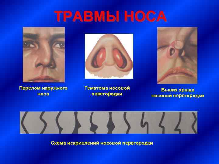 ТРАВМЫ НОСА Перелом наружного носа Гематома носовой перегородки Вывих хряща носовой перегородки Схема искривлений
