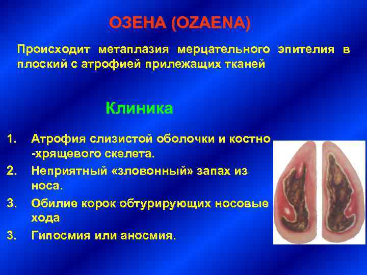 ОЗЕНА (OZAENA) Происходит метаплазия мерцательного эпителия в плоский с атрофией прилежащих тканей Клиника 1.