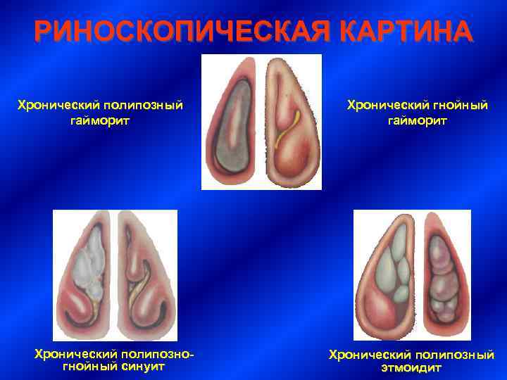 РИНОСКОПИЧЕСКАЯ КАРТИНА Хронический полипозный гайморит Хронический полипозногнойный синуит Хронический гнойный гайморит Хронический полипозный этмоидит