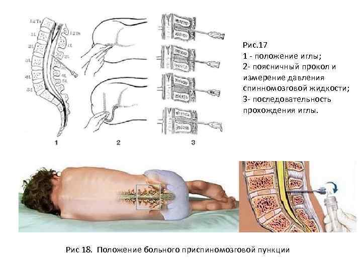 Рис. 17 1 - положение иглы; 2 - поясничный прокол и измерение давления спинномозговой