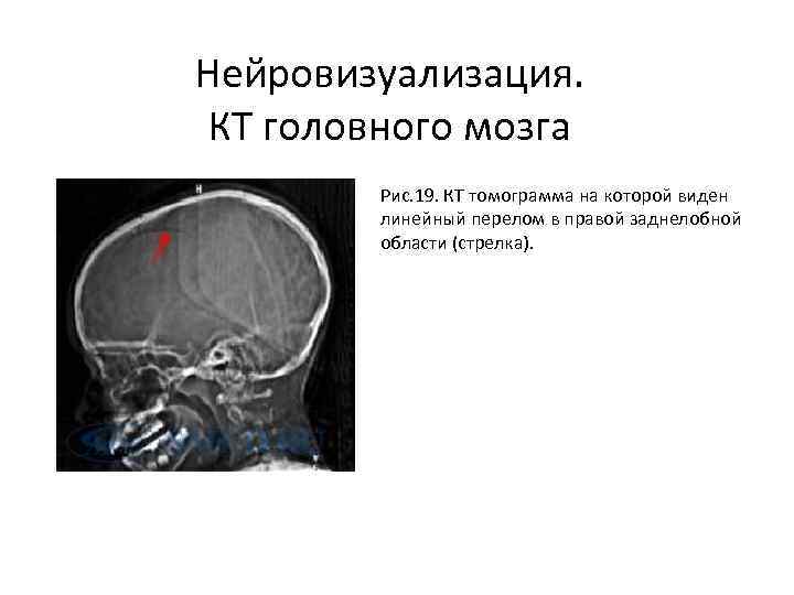 Нейровизуализация. КТ головного мозга Рис. 19. КТ томограмма на которой виден линейный перелом в