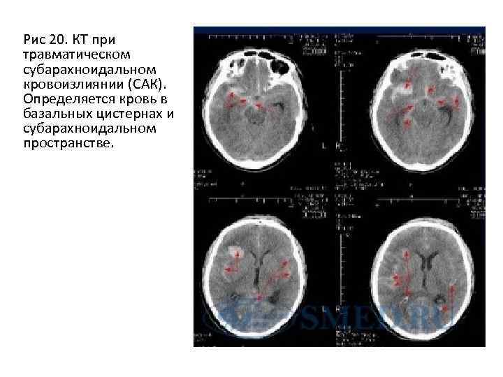 Рис 20. КТ при травматическом субарахноидальном кровоизлиянии (САК). Определяется кровь в базальных цистернах и