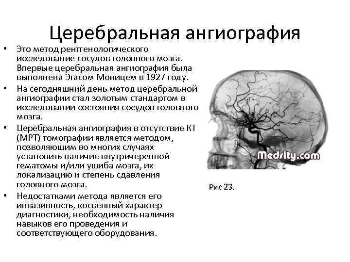 Церебральная ангиография • Это метод рентгенологического исследование сосудов головного мозга. Впервые церебральная ангиография была