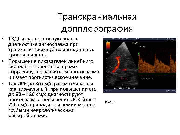 Транскраниальная допплерография • ТКДГ играет основную роль в диагностике ангиоспазма при травматических субарахноидальных кровоизлияниях.