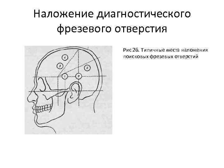 Наложение диагностического фрезевого отверстия Рис 26. Типичные места наложения поисковых фрезевых отверстий 