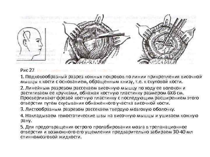 Рис 27. Резекционная трепанация черепа 1. Подковообразный разрез кожных покровов по линии прикрепления височной