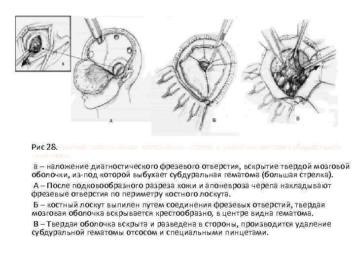 Рис 28. Костно-пластическая трепанация черепа и удаление острой субдуральной гематомы. а – наложение диагностического