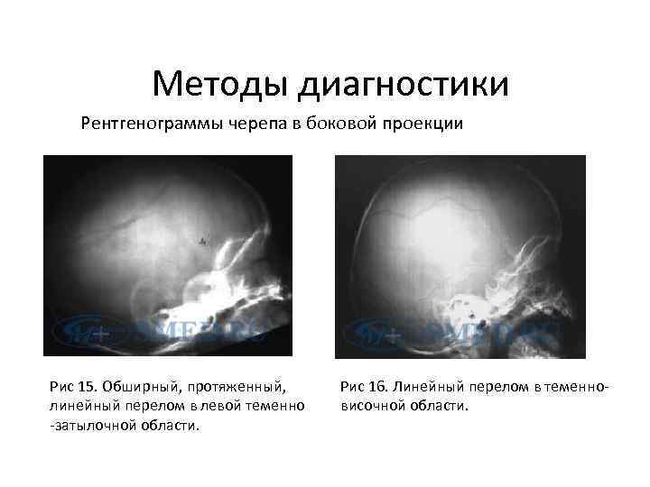 Методы диагностики Рентгенограммы черепа в боковой проекции Рис 15. Обширный, протяженный, линейный перелом в