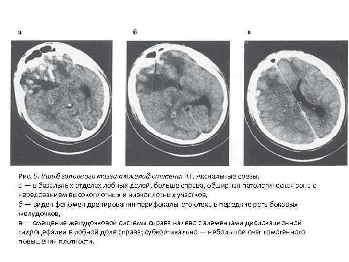 Рис. 5. Ушиб головного мозга тяжелой степени. КТ. Аксиальные срезы, а — в базальных