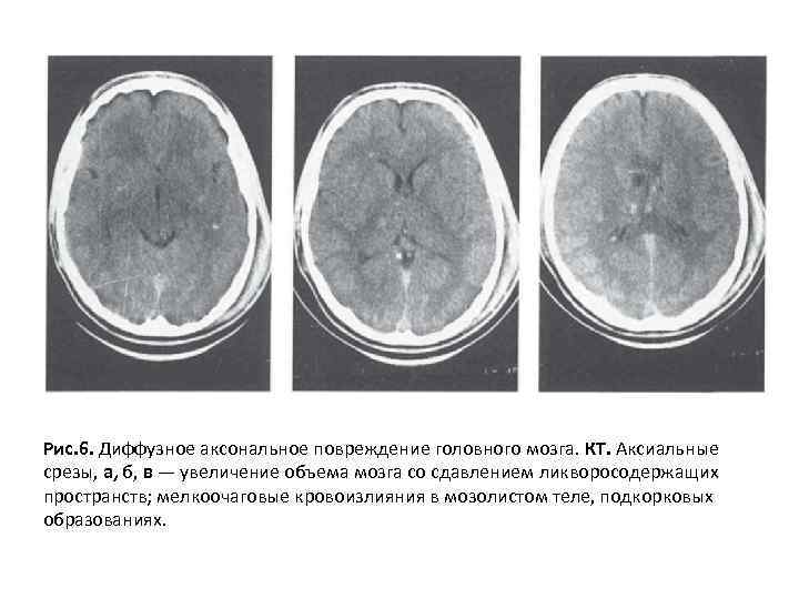 Рис. 6. Диффузное аксональное повреждение головного мозга. КТ. Аксиальные срезы, а, б, в —