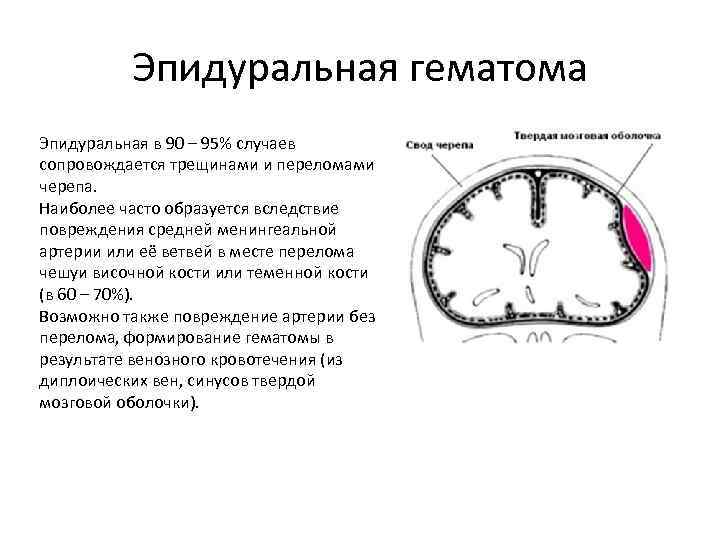 Эпидуральная гематома Эпидуральная в 90 – 95% случаев сопровождается трещинами и переломами черепа. Наиболее