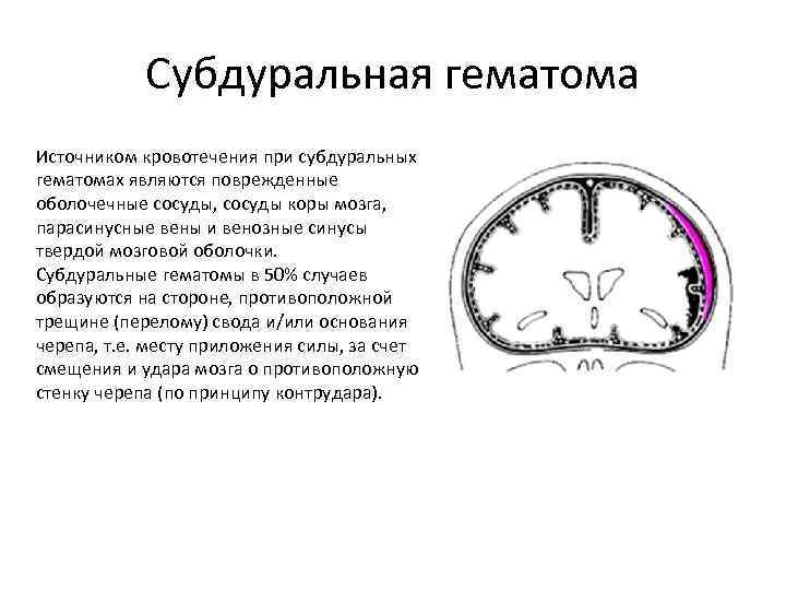 Субдуральная гематома Источником кровотечения при субдуральных гематомах являются поврежденные оболочечные сосуды, сосуды коры мозга,