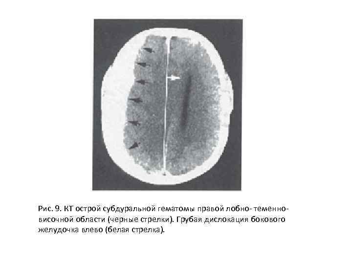Рис. 9. КТ острой субдуральной гематомы правой лобно- теменновисочной области (черные стрелки). Грубая дислокация
