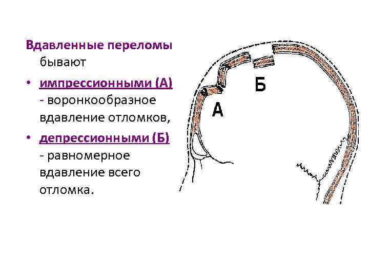 Вдавленные переломы бывают • импрессионными (А) - воронкообразное вдавление отломков, • депрессионными (Б) -