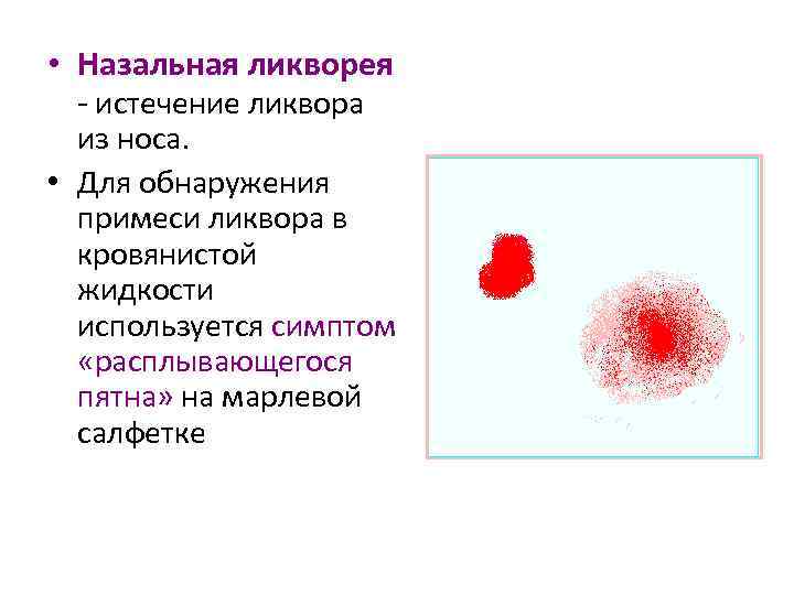  • Назальная ликворея - истечение ликвора из носа. • Для обнаружения примеси ликвора