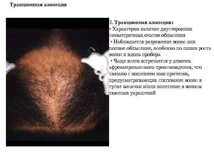 Тракционная алопеция 2. Тракционная алопеция: • Характерно наличие двусторонних симметричных очагов облысения • Наблюдается