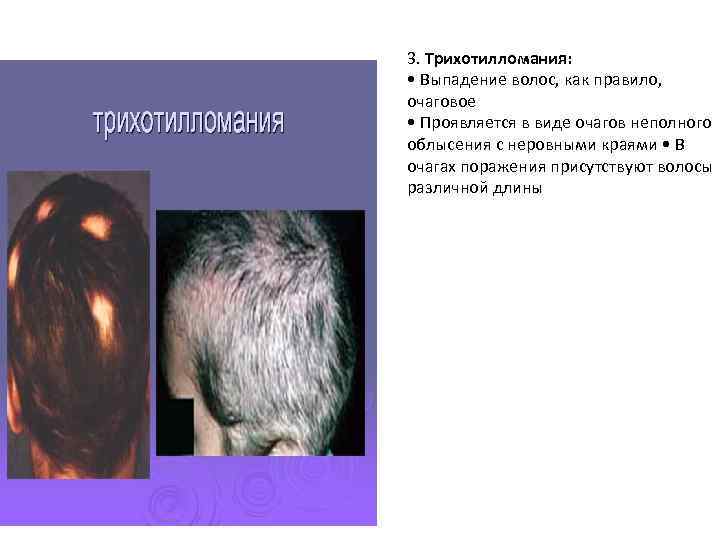 3. Трихотилломания: • Выпадение волос, как правило, очаговое • Проявляется в виде очагов неполного