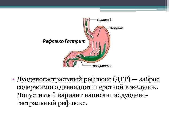  • Дуоденогастральный рефлюкс (ДГР) — заброс содержимого двенадцатиперстной в желудок. Допустимый вариант написания: